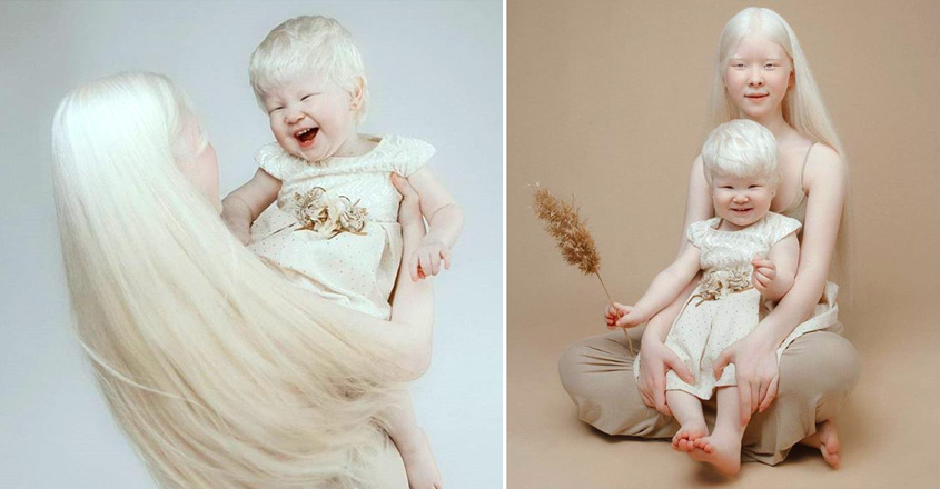 ‘മോഡലിങ് രംഗത്ത് തരംഗമായി ആൽബിനിസം ബാധിച്ച സഹോദരിമാർ, Albino sisters, Kazakhstan, became, models, social media post, Kidsclub, Manorama Online